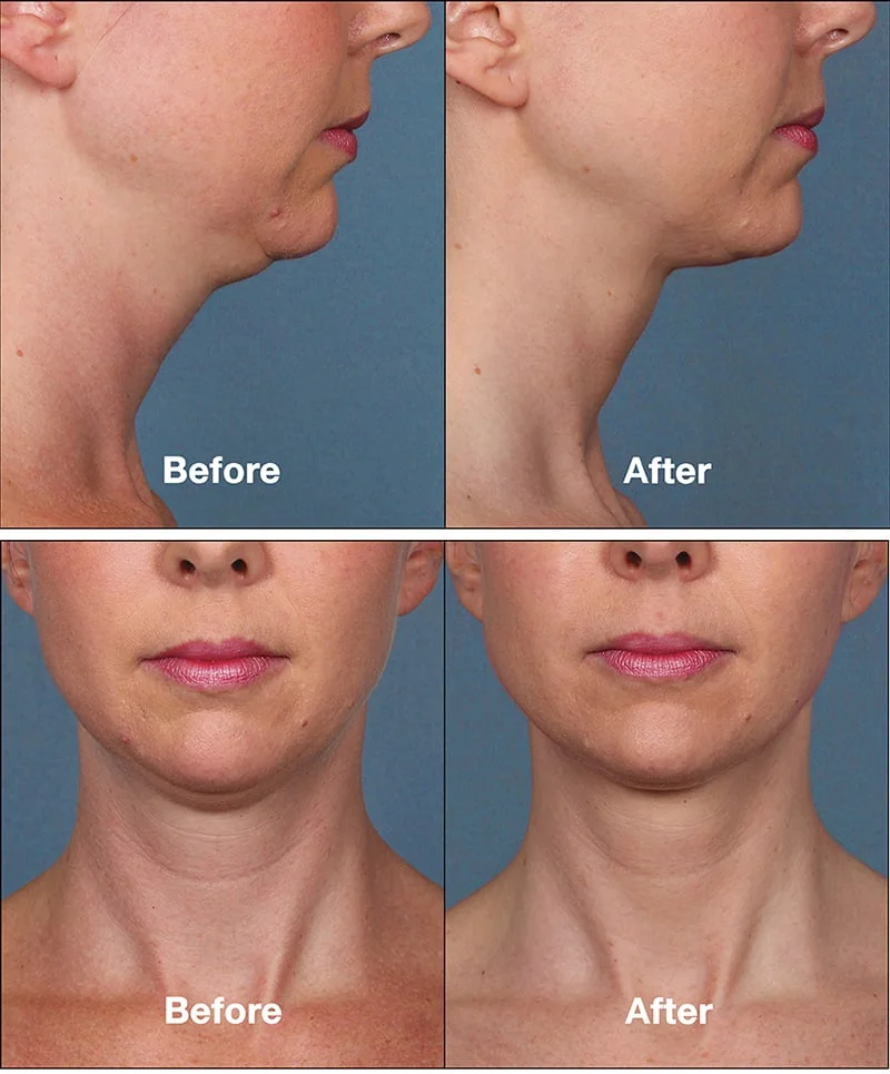 Kybella Before + After Photos - Purely Aesthetics
